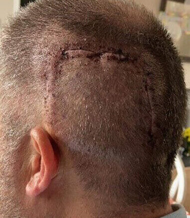 scar following surgery to remove a brain tumour