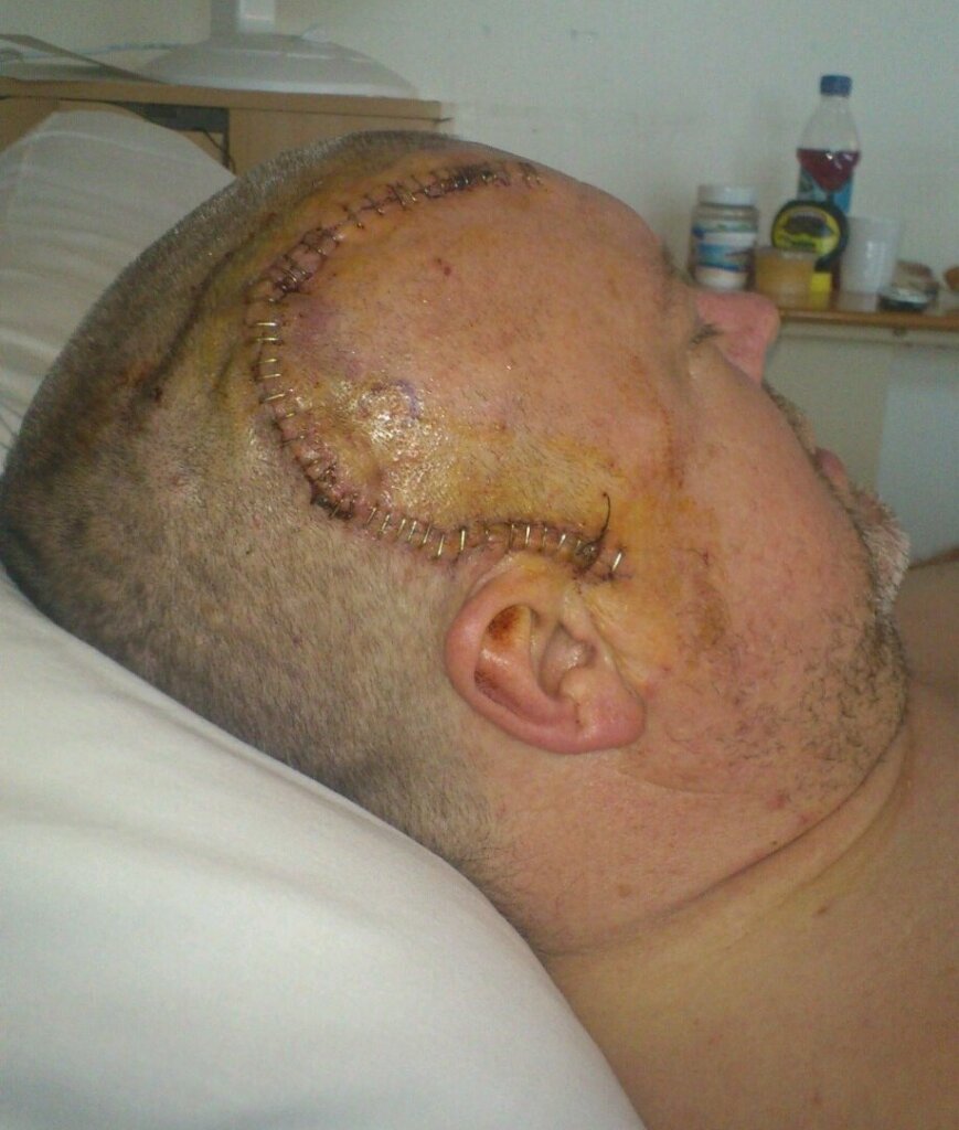 Close-up of man in hospital bed with scar and stitches after brain tumour surgery