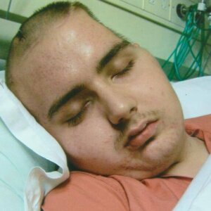 Close up of young man sleeping in hospital bed, showing large skull defect after craniotomy