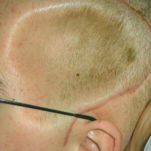 Side of man's head showing craniotomy scar and defect in skull