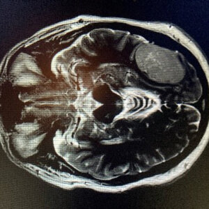 CT scan showing large brain tumour