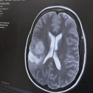 Hannah's brain scan