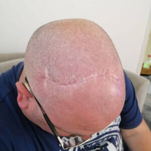 Looking down on a bald head with a well-healed scar across the top of the head